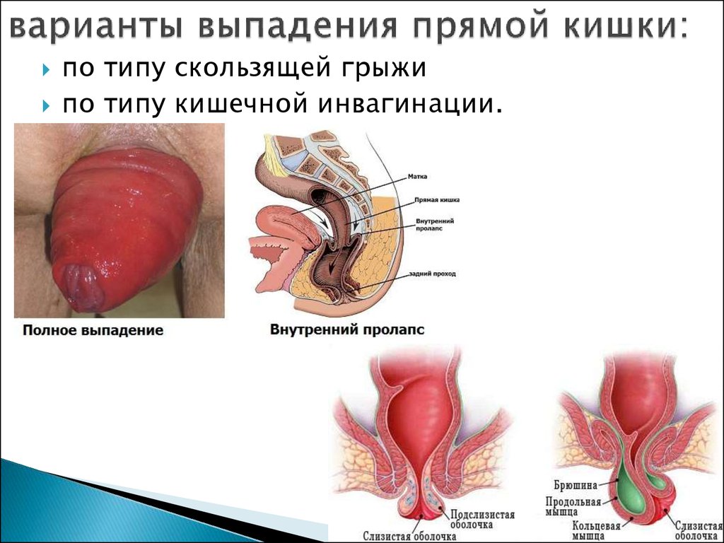 Hemorrhoid herpes anus