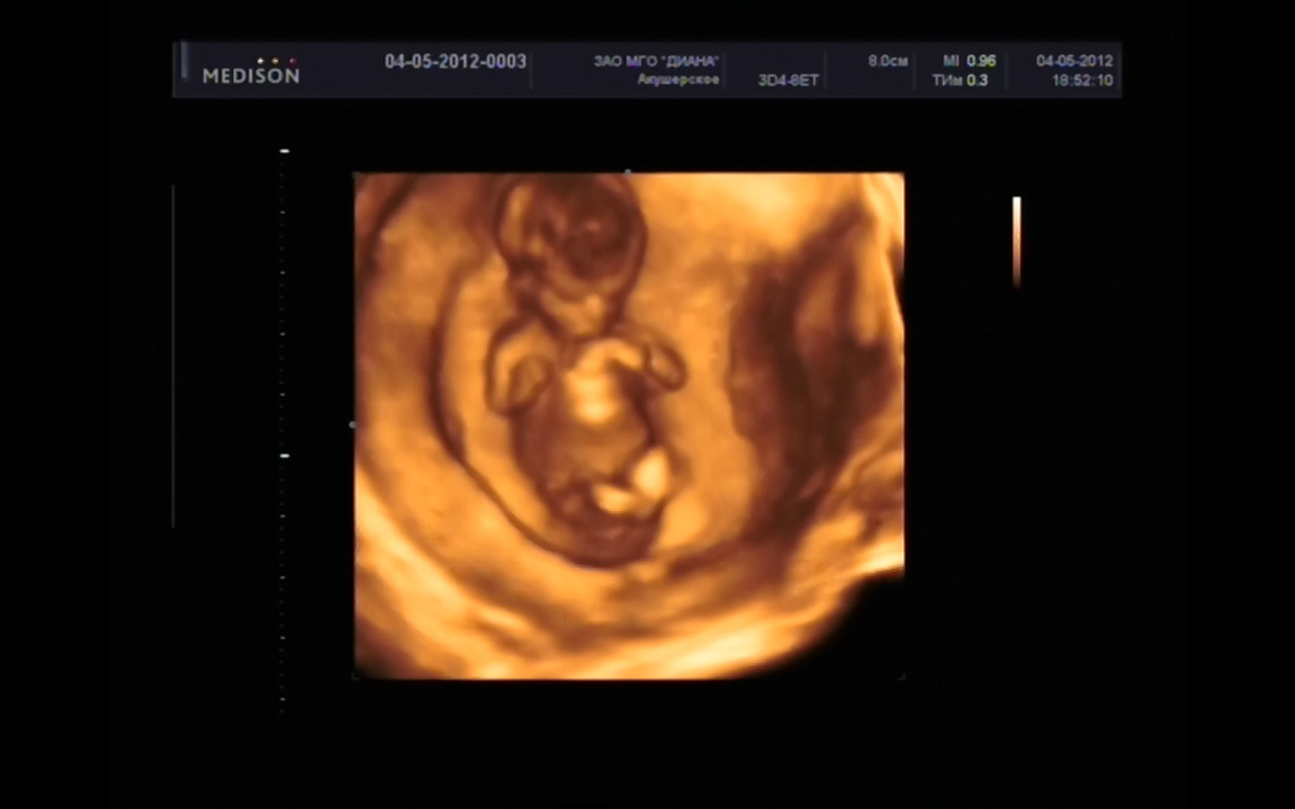 УЗИ 13 недель беременности мальчик