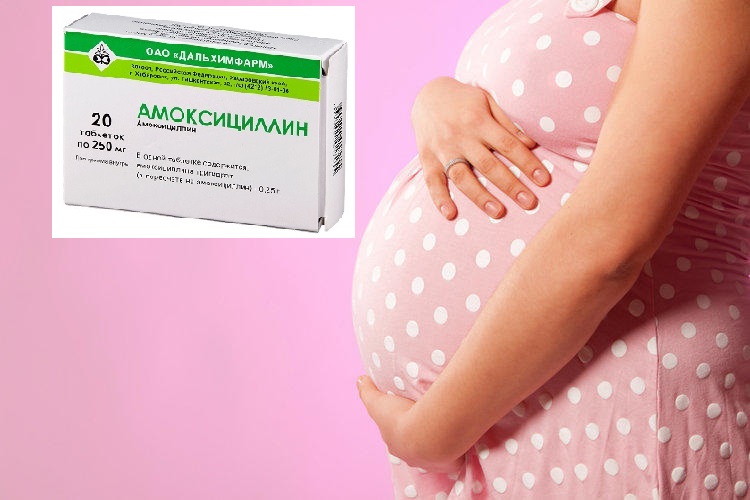 Можно пить антибиотики при беременности. Амоксициллин для беременных. Амоксициллин приибеременности. Амоксициллин во 2 триместре беременности. Антибиотики при беременности.